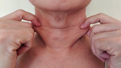 Portrait showing the fingers squeezing flabbiness cellulite adipose hanging under the neck, problem...