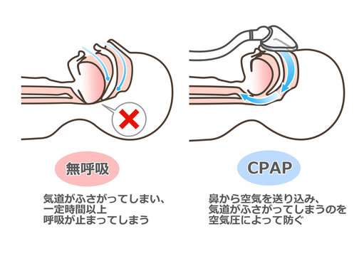CPAPの図解