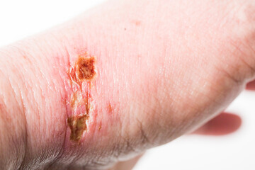 chemical burn on the wrist skin with hydroxide sodium acid, by striping paint from wood furniture....