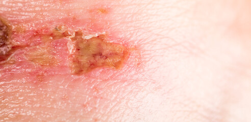 chemical burn on the wrist skin with hydroxide sodium acid, by striping paint from wood furniture. Household accident, because of gloves to sharp