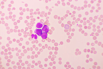 Acute promyelocytic leukemia cells or APL, analyze by microscope, original magnification 1000x