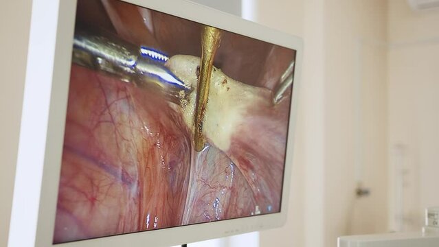 View of the monitor in laparoscopy operation. Operation by laparoscopic method with output of patient 's internal organs to the monitor