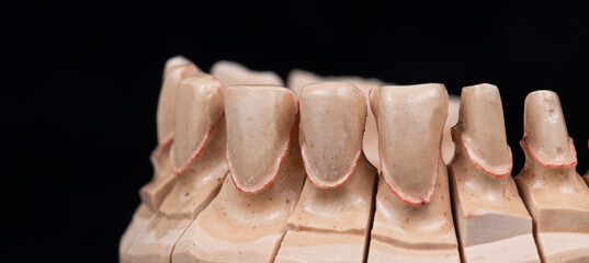 press ceramic crons and veneers a 1 color