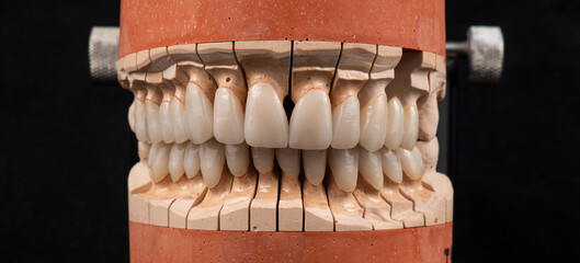 press ceramic crons and veneers a 1 color