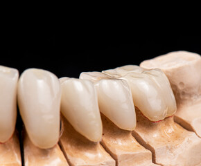 press ceramic crons and veneers a 1 color