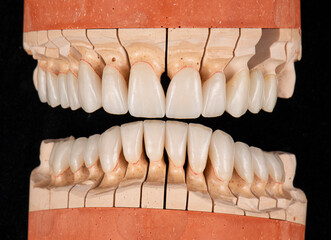 press ceramic crons and veneers a 1 color