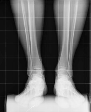 Radiografia piernas RX