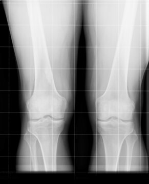 Radiografia rodillas rx