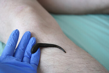 A leech sucks blood on the leg of a patient in a hirudotherapy salon