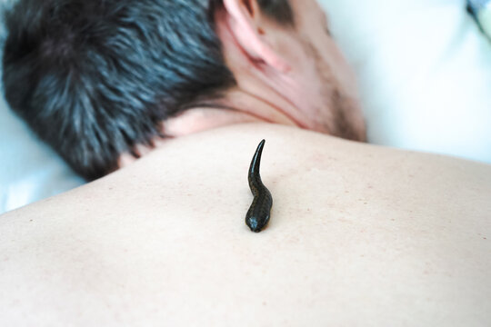 A leech sucks blood on the back of a patient in a hirudotherapy salon