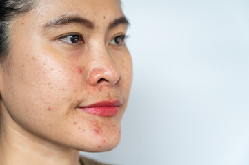 Obraz premium Close up of Asian woman having acne inflamed on her face with white copy space. Inflamed acne consists of swelling, redness, and pores that are deeply clogged with bacteria, oil, and dead skin cells.