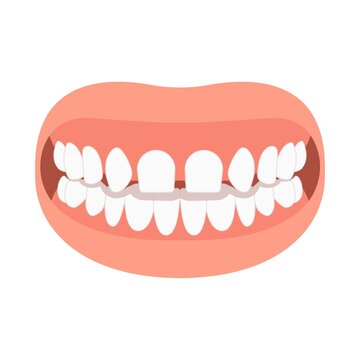 bad bite teeth mouth open deep gum Joint pain jaw surgery corrective bone oral smile Lower Weak Chin health extra Spacing Anterior fixed