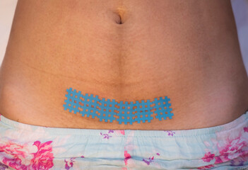 Taping a kinesiology tape on a scar after a caesarean section. Recovery after childbirth.