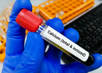 Blood sample for calcium (total and ionized) test. bone disease.