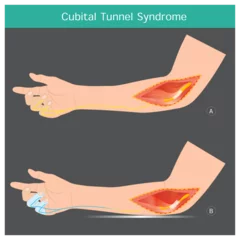 Foto op Canvas Cubital Tunnel Syndrome. A condition that involves pressure or stretching of the ulnar nerve in arms which can cause numbness or tingling in the ring and small fingers. © PATTARAWIT
