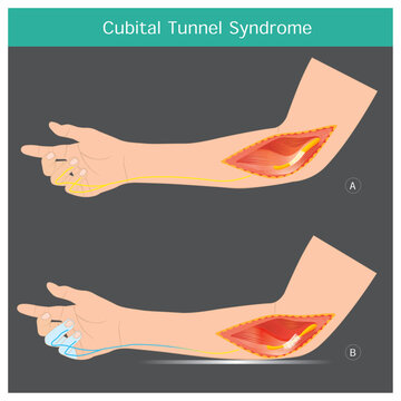 Cubital Tunnel Syndrome. A condition that involves pressure or stretching of the ulnar nerve in arms which can cause numbness or tingling in the ring and small fingers.