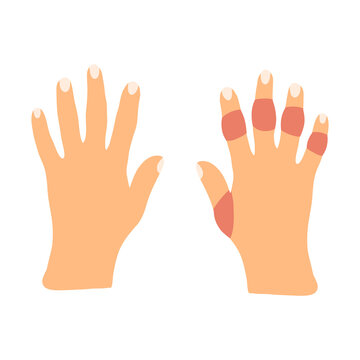 Hands with rheumatoid arthritis disease in cartoon flat style. Vector illustration of sick stiffness swollen joints. Human disorder