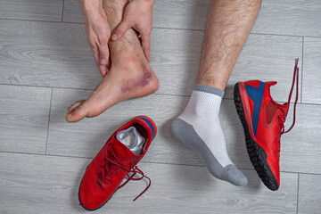 Ankle injury with dislocation and sprains. Fracture or Leg sprain injury of young sports man. 