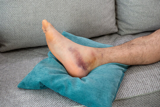 Sprained Ankle" Images – Browse 3,167 Stock Photos, Vectors, and Video |  Adobe Stock