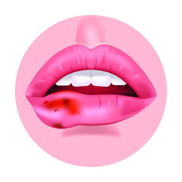 Lip cancer. Tumor with blood. Open mouth. Vector illustration