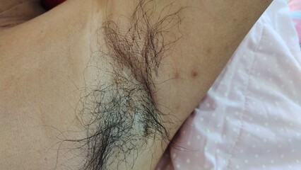 Portrait showing fungus under the armpit and long armpit hair of the man, concept health care.