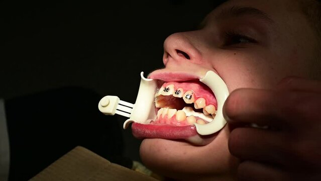The orthodontist applies braces to the student's teeth, crooked children's permanent teeth.