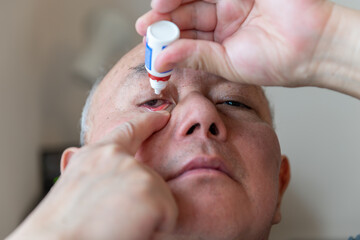 A man applying anti bacterial eye drops to a red infected eye.