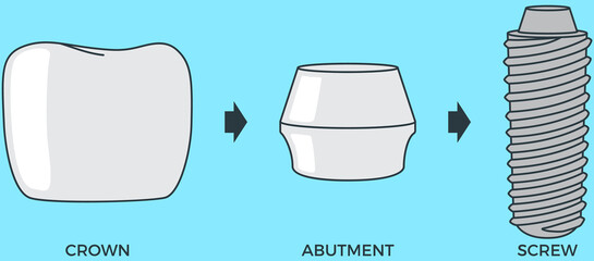 Bolts, screws and crown prosthesis structure. Implantation dentistry, stomatology. Tooth care, treatment, recovery. Dental implant creation scheme. Sequence of connection of screw, abutment and crown