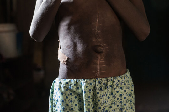 Cropped image of teenage boy, a police brutality victim,  with of surgical scars on his abdomen in Ogbomoso, Nigeria