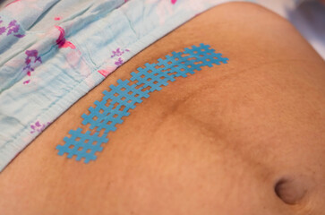 Taping a kinesiology tape on a scar after a caesarean section. Recovery after childbirth.