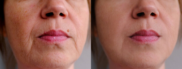 Before and after cosmetic operation. close-up of face middle-aged woman in two versions, small...
