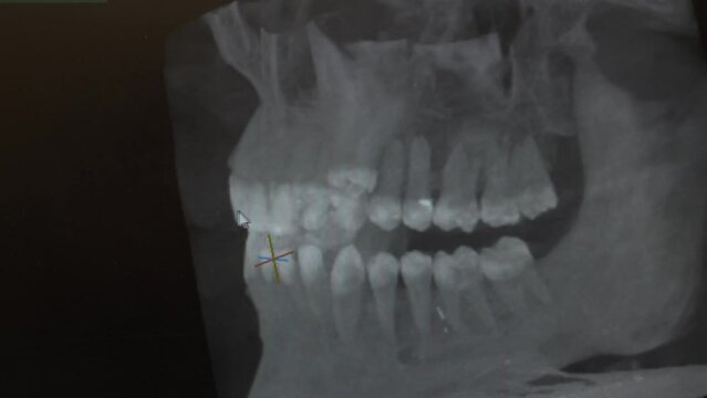 3d X-ray image of the jaw. tomography