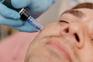 Collagen Induction Therapy Microneedling For the face of a European man close-up