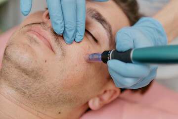 Collagen Induction Therapy Microneedling For the face of a European man close-up 2