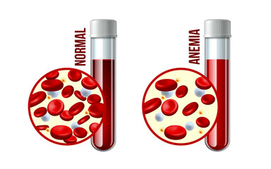 Iron deficiency anemia.The difference of Anemia amount of red blood cell and normal. - 495508590