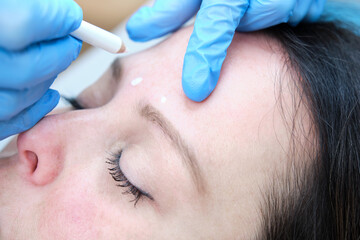 marking with white dermographic pencil on the forehead for filling with botulinum toxin