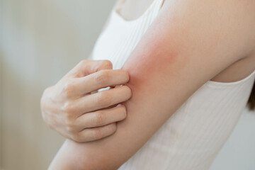 Dermatology, asian young woman, girl allergy, allergic reaction from atopic, insect bites on her arm, hand in scratching itchy, itch red spot or rash of skin. Healthcare, treatment of beauty.