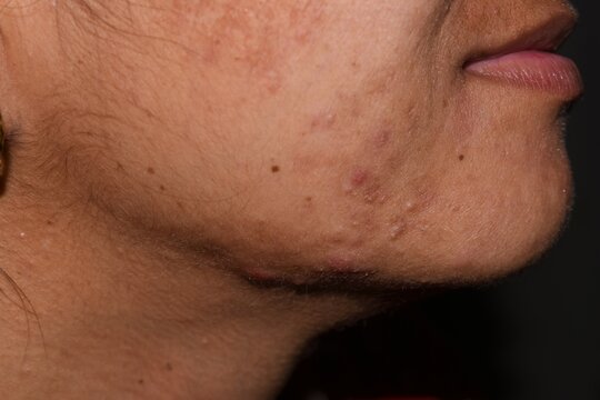 Pimples, Dark Spots and open pores on face closeup background