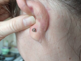 Acne blackheads behind the ear