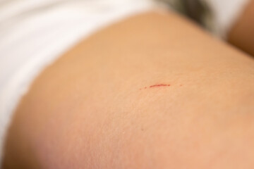 A bleeding wound on a broken skin