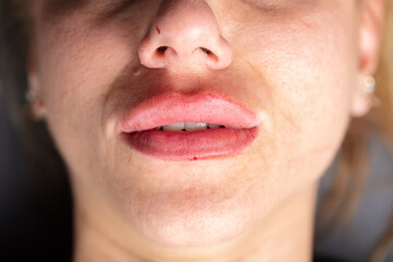 Obraz premium Young lady getting injections for bigger, fuller lips. The woman in the beauty salon. Plastic surgery clinic. 