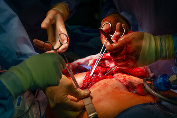 Surgical operation, closeup on operating field and hands of surgeons