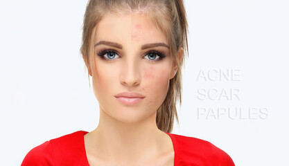 Post-Acne Marks .Treating Acne Scars.Acne Scar Removal