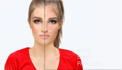 Post-Acne Marks .Treating Acne Scars.Acne Scar Removal