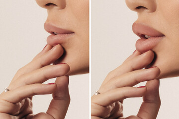 Woman's face side view close-up before and after Botox lip filler injections. Lip augmentation....