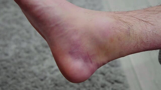 Ankle injury with dislocation and sprains. Fracture or Leg sprain injury of young sports man. 