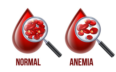 Iron deficiency anemia.The difference of Anemia amount of red blood cell and normal. - 495844300