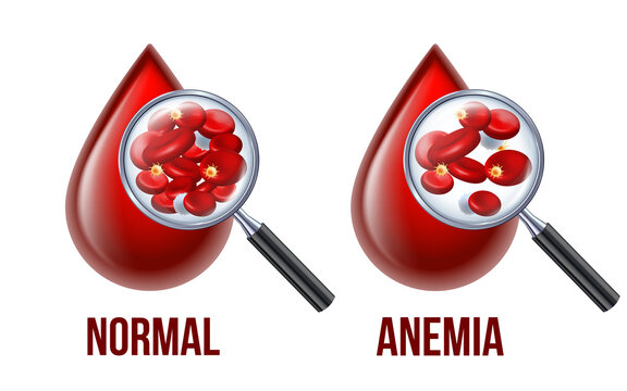 Iron deficiency anemia.The difference of Anemia amount of red blood cell and normal.