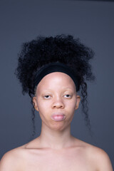 portrait of an albino girl