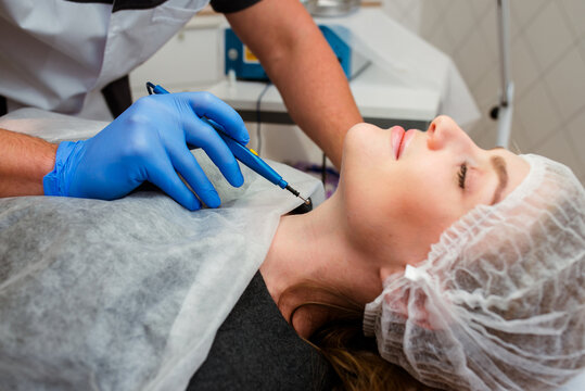Medical treatment removal of birthmark from female patient's neck. Female dermatologist surgeon using electrocautery for removing mole. Radio wave electrocoagulation remove method. Close up